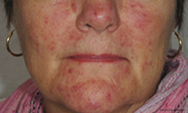 Rosacea eller « ansiktsrosen » er en betennelsessykdom i talgkjertlene i ansiktet som vanligst opptrer fra 30-40 års alder med et kronisk ...