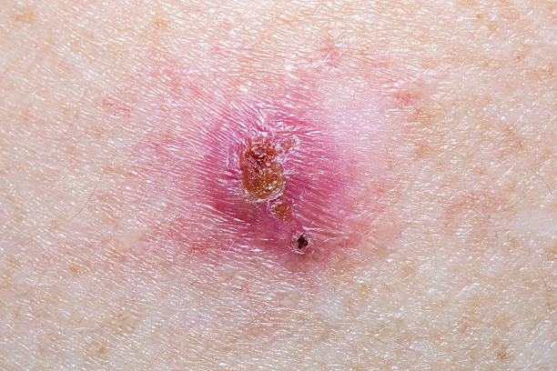 Close-up of a Basal Cell Carcinoma